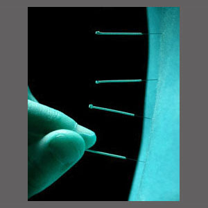 Acupuncture for Spinal Stenosis