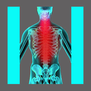 Acute Spinal Stenosis