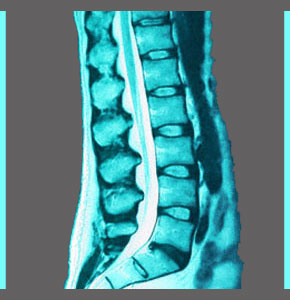 Asymptomatic Spinal Stenosis