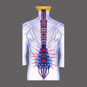 Cauda Equina Syndrome Spinal Stenosis