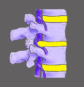 Central Spinal Stenosis