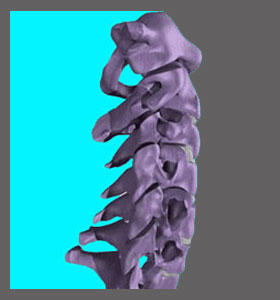 Cervical Foraminal Stenosis