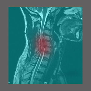 Cervical Spinal Stenosis Diagnosis