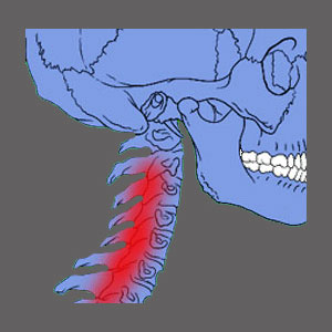 Cervical Spinal Stenosis Treatment