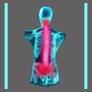 Chronic Spinal Stenosis