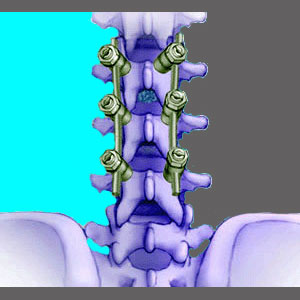 Surgical Fusion for Spinal Stenosis