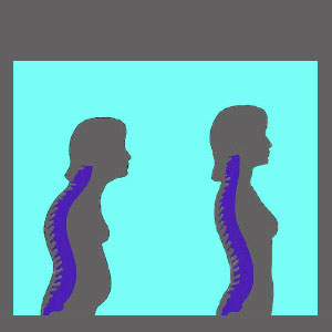 Genetic Spinal Stenosis