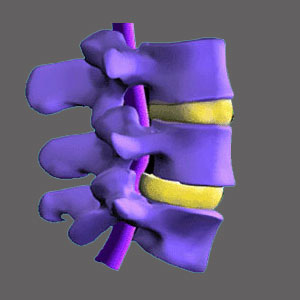 Lateral Spinal Stenosis