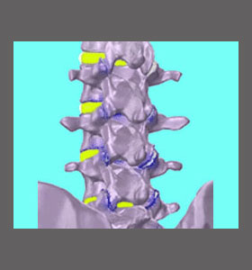 Lumbar Foraminal Stenosis