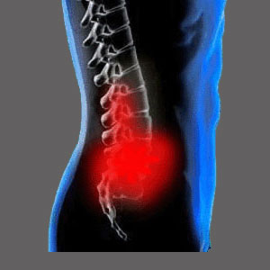 Lumbar Spinal Stenosis