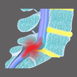 Lumbosacral Spinal Stenosis