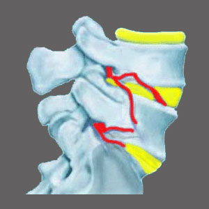 Narrow Neuroforamen