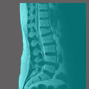 Narrowed Spinal Canal