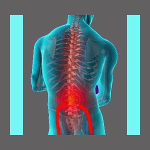 Sciatica from Spinal Stenosis