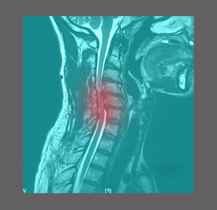 Second Opinion on Spinal Stenosis