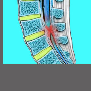 Severe Spinal Stenosis