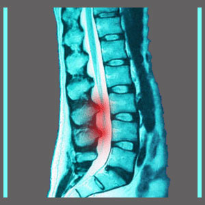 Spinal Canal Stenosis