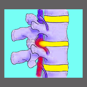 Spinal Cord Compression