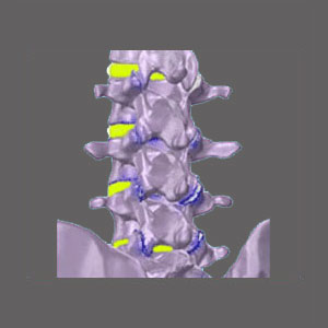 Spinal Stenosis and Osteoporosis