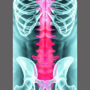 Spinal Stenosis Back Injury