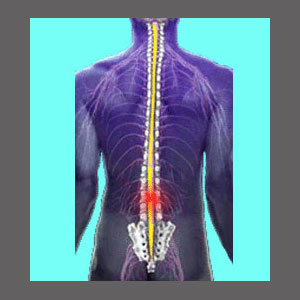 Spinal Stenosis Explanation