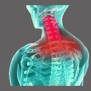Spinal Stenosis Flare Up
