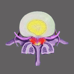 Spinal Stenosis from a Herniated Disc