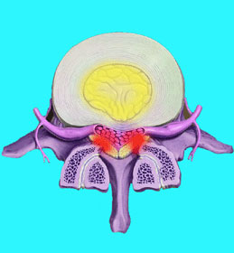  spinal-stenosis-from-a-herniated-disc-41 - Spinal Stenosis Bildidee 