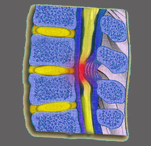 Spinal Stenosis from Arthritis