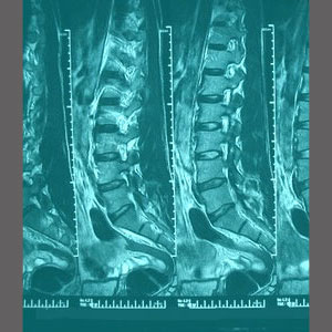 Spinal Stenosis from Degenerative Disc Disease