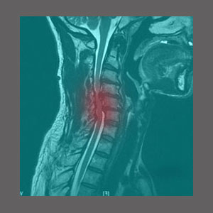 Spinal Stenosis from Fractured Vertebrae