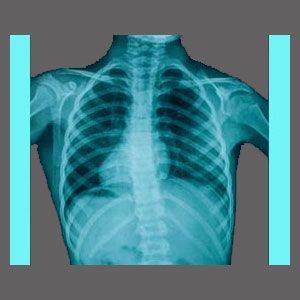 Spinal Stenosis from Scoliosis