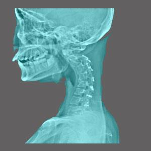 Spinal Stenosis from Spinal Curvature