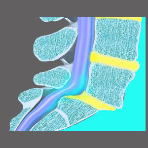 Spinal Stenosis from Spondylolisthesis