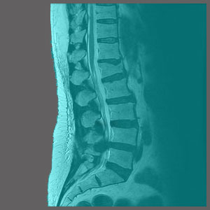 Spinal Stenosis in Children