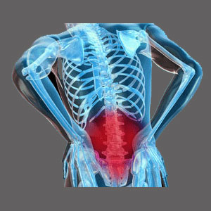 Spinal Stenosis in the Lower Back