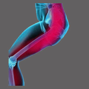 Spinal Stenosis Leg Pain