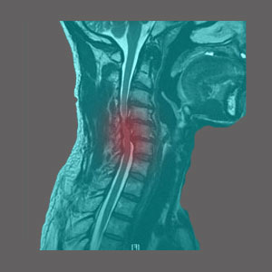 Spinal Stenosis MRI