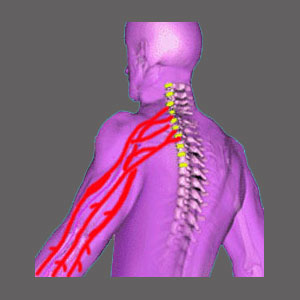 Spinal Stenosis Nerve Pain