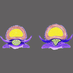 Spinal Stenosis Osteophytes