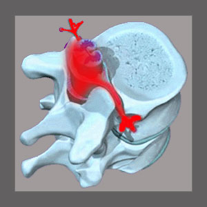 Spinal Stenosis Products