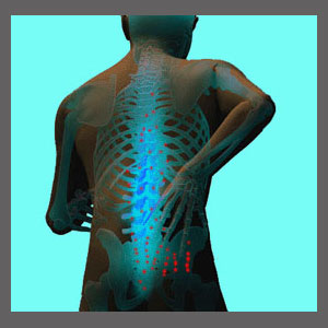 Spinal Stenosis Tingling