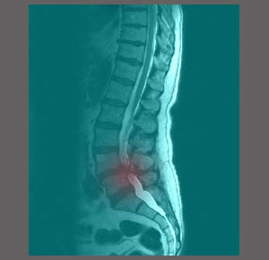 Spinal Stenosis Treatment