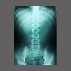 Spinal Stenosis X-Ray