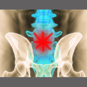 Stenosis in the Lower Spine