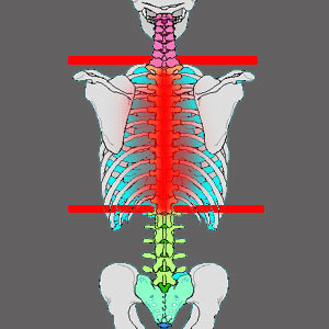 Stenosis in the Thoracic Spine