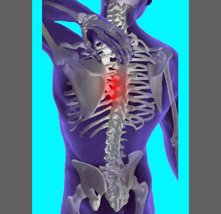 Thoracic Foraminal Stenosis