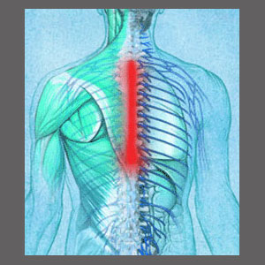 Thoracic Spinal Stenosis