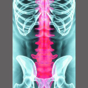 Dr. Sarno and Spinal Stenosis