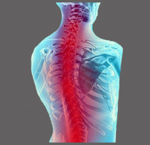 Developed Spinal Stenosis